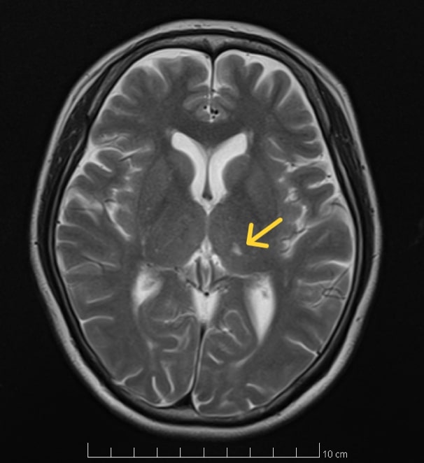 頭部MRI(脳梗塞)