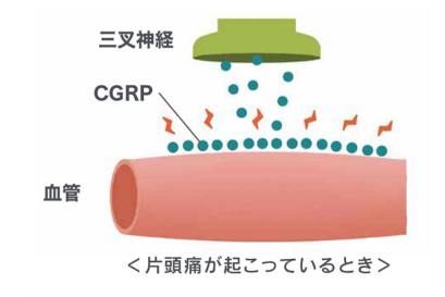 片頭痛発作時